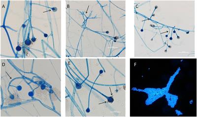 The application of metagenomic next-generation sequencing in patients with infection or colonization caused by Lichtheimia species